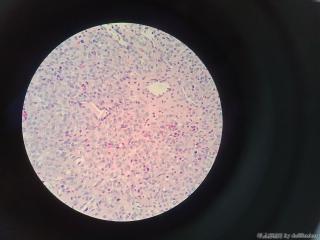 右小指肿物，化脓性肉芽肿/小叶性毛细血管瘤？图5