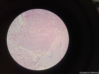 右小指肿物，化脓性肉芽肿/小叶性毛细血管瘤？图3