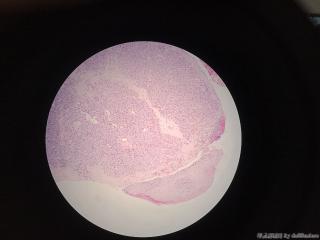 右小指肿物，化脓性肉芽肿/小叶性毛细血管瘤？图4