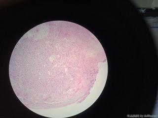 右小指肿物，化脓性肉芽肿/小叶性毛细血管瘤？图1