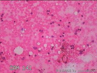 甲状腺细针穿刺涂片图10