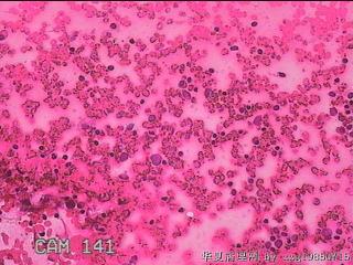 甲状腺细针穿刺涂片图14