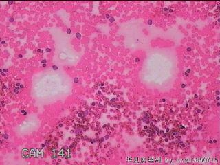 甲状腺细针穿刺涂片图8