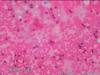 甲状腺细针穿刺涂片图11