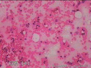 甲状腺细针穿刺涂片图17