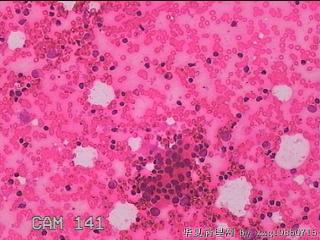 甲状腺细针穿刺涂片图6