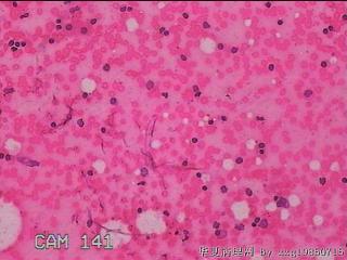 甲状腺细针穿刺涂片图13
