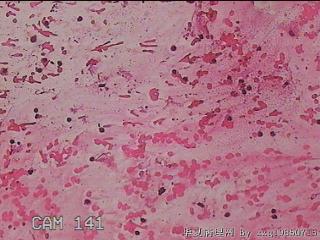 甲状腺细针穿刺涂片图18