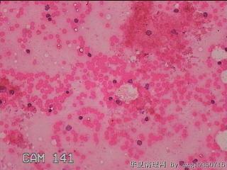 甲状腺细针穿刺涂片图23