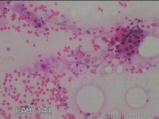 甲状腺细针穿刺涂片图4