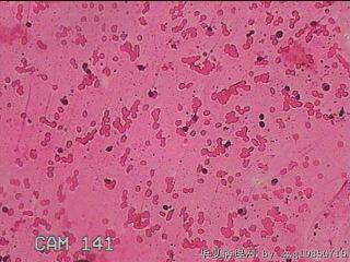 甲状腺细针穿刺涂片图25