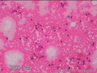 甲状腺细针穿刺涂片图9