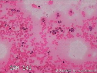 甲状腺细针穿刺涂片图15