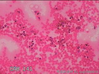 甲状腺细针穿刺涂片图24