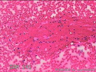 甲状腺细针穿刺涂片图3