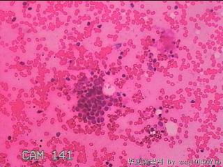 甲状腺细针穿刺涂片图1