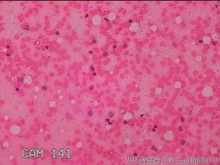 甲状腺细针穿刺涂片图26