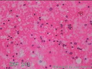 甲状腺细针穿刺涂片图12