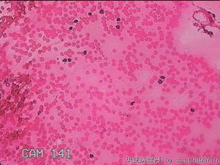 甲状腺细针穿刺涂片图30
