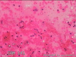 甲状腺细针穿刺涂片图19
