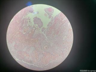 肛门赘生物图6