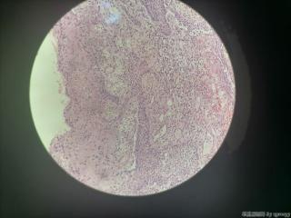肛门赘生物图12
