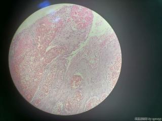肛门赘生物图10