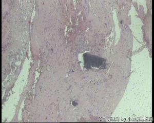 急！！！请老师看看股骨头坏死，髋臼增生物怎么报？图7