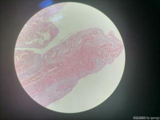 肛门赘生物图4