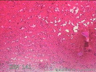 甲状腺细针穿刺涂片图17