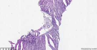 肝结节穿刺活检，肝细胞空泡化变性？异型增生？图7
