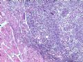 欣赏--甲状腺肿瘤图1