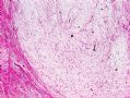 (转贴)颈后软组织肿物－－肌内粘液瘤(intramuscular myxoma)图2