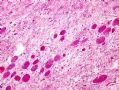 (转贴)颈后软组织肿物－－肌内粘液瘤(intramuscular myxoma)图3