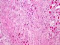 (转贴)颈后软组织肿物－－肌内粘液瘤(intramuscular myxoma)图4