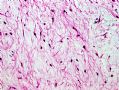 (转贴)颈后软组织肿物－－肌内粘液瘤(intramuscular myxoma)图8