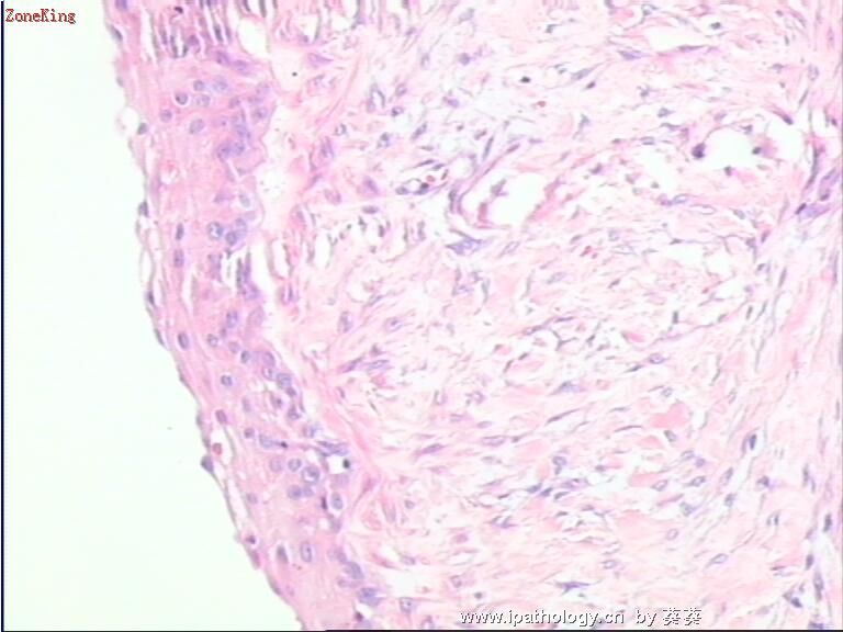 甲状腺腺瘤？图7