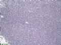 江西省第34届病理学年会(2006年)读片会病例200613图12