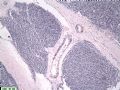 江西省第34届病理学年会(2006年)读片会病例200613图13