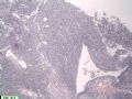 江西省第34届病理学年会(2006年)读片会病例200613图17