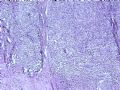 乳腺肿瘤－－结外NK/T细胞淋巴瘤图2