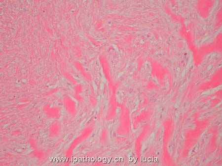颈部肿物-Keloid scar图2