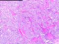 甲状腺肿瘤图1