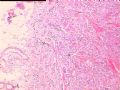 甲状腺肿瘤图3