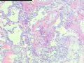 求教:结甲癌变?图4