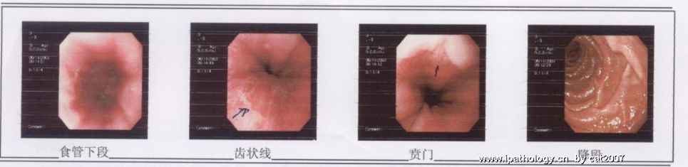 来讨论一下！！！ 这是否Barrett食管？图2