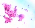 20071221腹水涂片图7