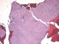 子宫刮出物_超常胎盘反应 exaggerated placental site图1