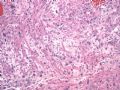 子宫刮出物_超常胎盘反应 exaggerated placental site图2