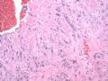 子宫刮出物_超常胎盘反应 exaggerated placental site图3